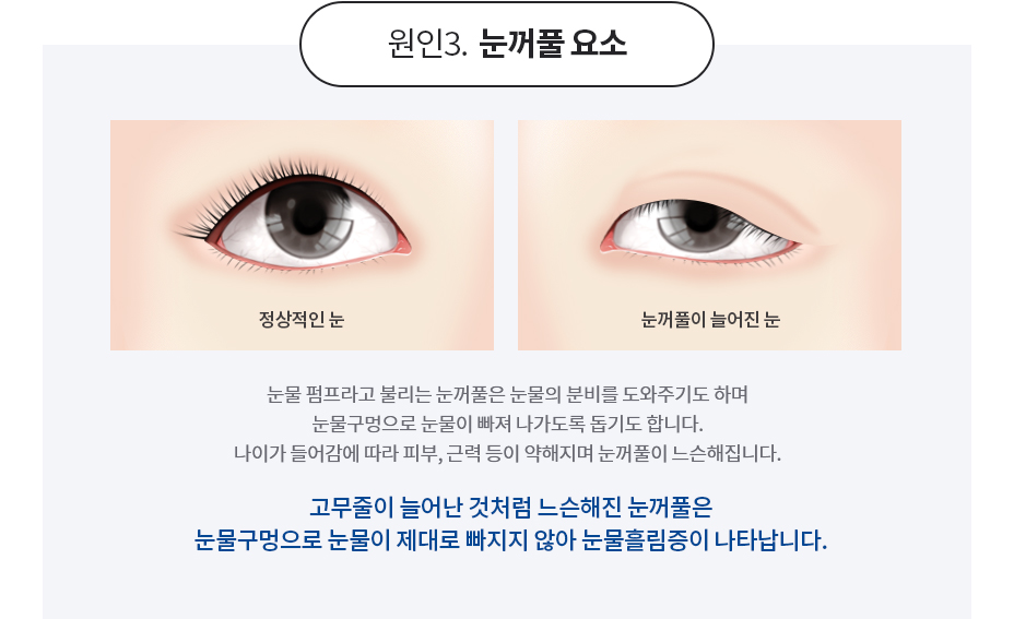 눈물흘림증의 원인