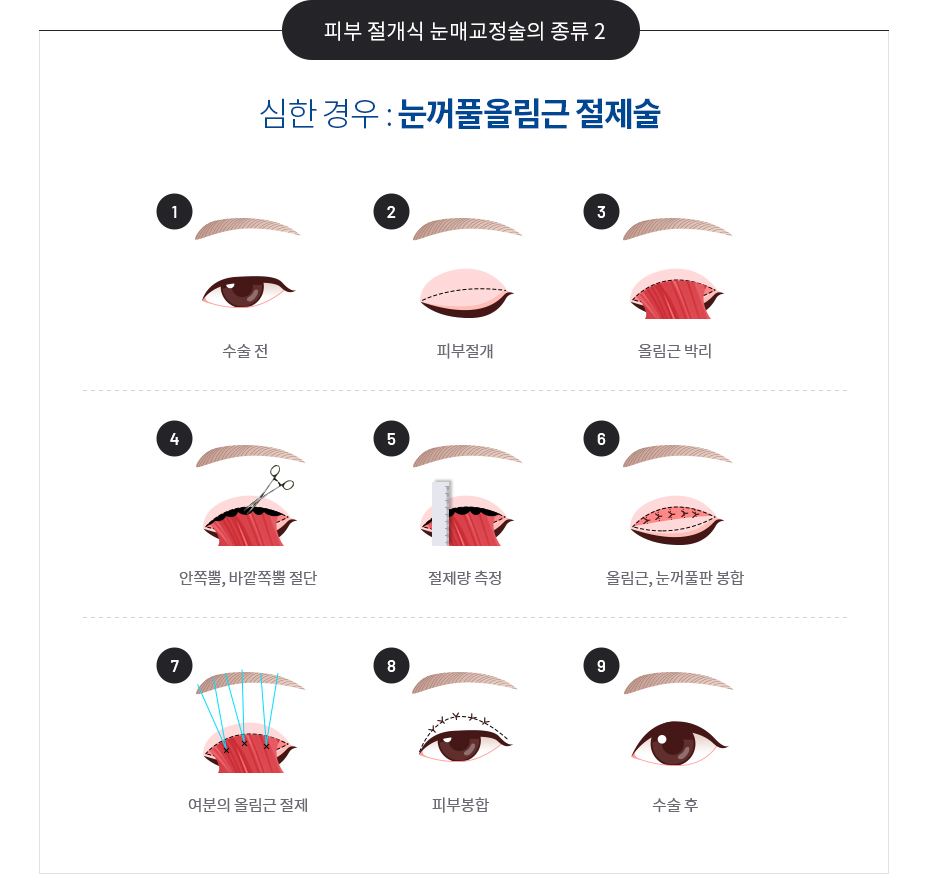 안검하수의 치료