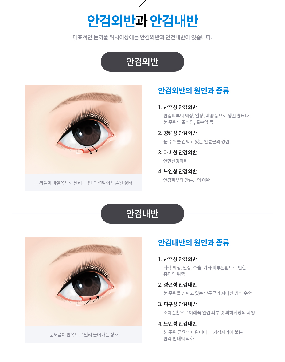 안검외반과 안검내반